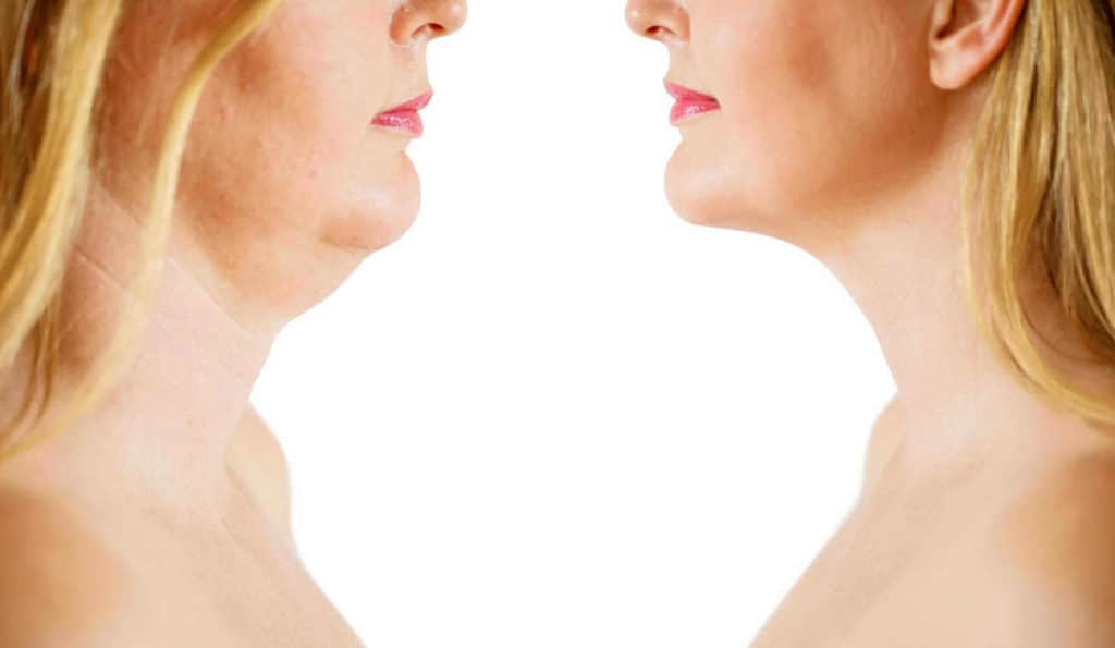 Double Chin treatment Leominster before and after results