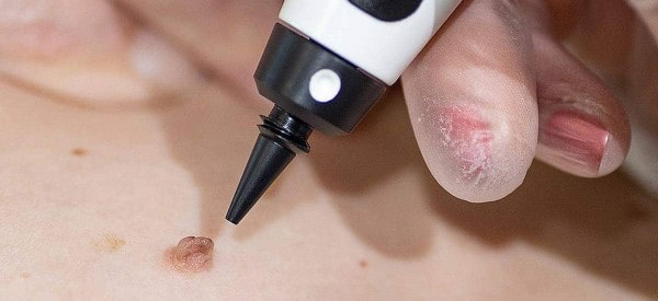 After Skin Tag Removal Leominster