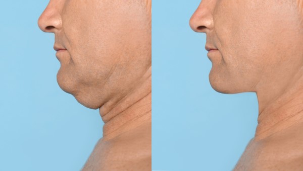 Which Non-Surgical Treatments Work Best for Jowls and Loose Skin Leominster?