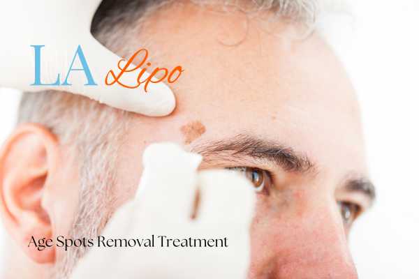 What Are the Most Effective Treatments for Age Spots Leominster?