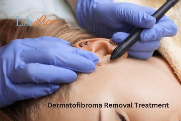 Dermatofibroma Removal Treatment Leominster