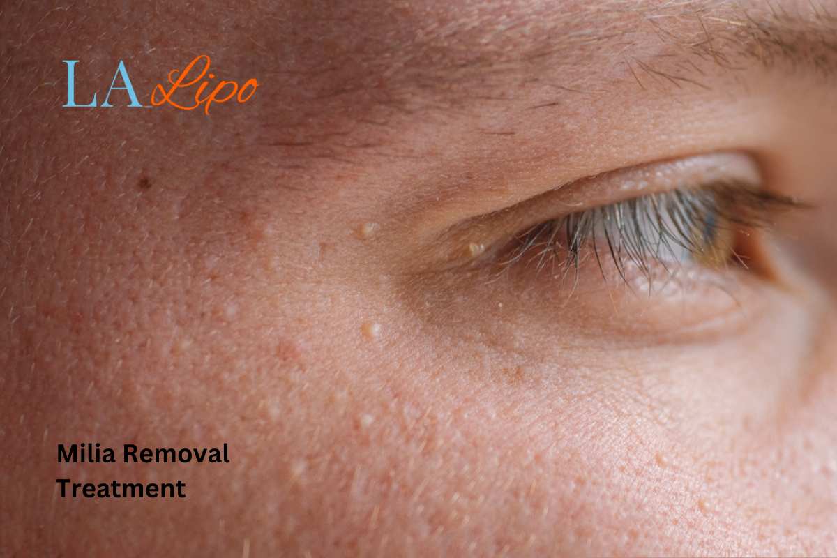 Cryopen Milia Removal: Is It the Easiest and Safest Option Leominster?