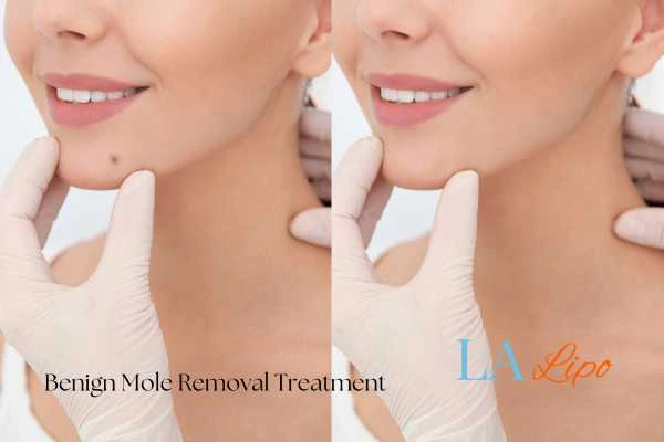 Before-and-after results following benign mole-removal treatment Leominster