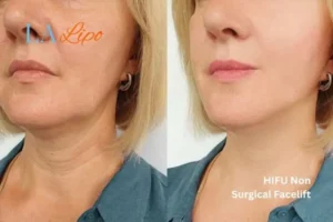 hi-fu for wrinkles Leominster before and after results