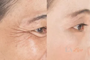 Before and after results of woman - HI-fu wrinkles reduction treatment Leominster