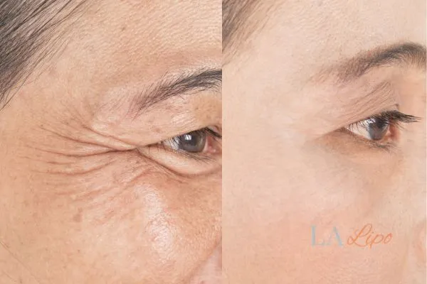 Before and after results of woman - HI-fu wrinkles reduction treatment Leominster