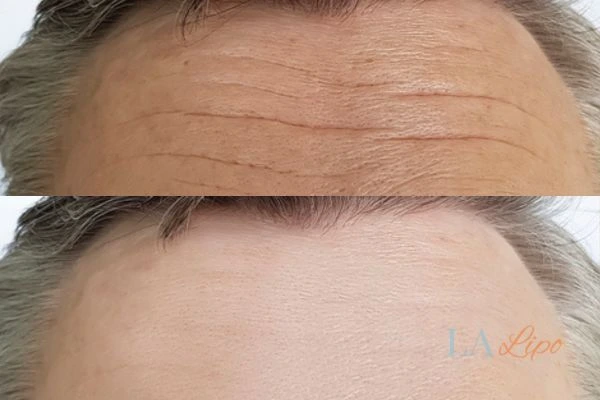 results of HIFU Leominster on mans forehead to help reduce lines and wrinkles