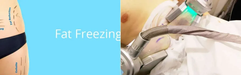 multi areas of a persons body having coolsculpting Leominster treatment
