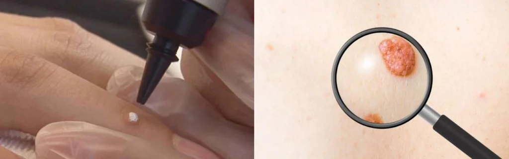 CryoPen practitioner Leominster assessing a benign mole before treatment