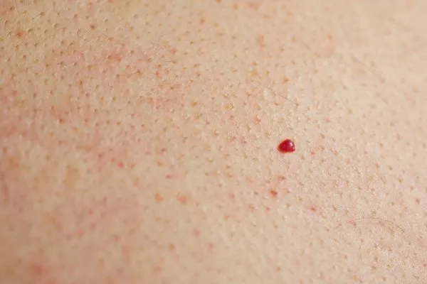 close up of a cherry angioma Leominster