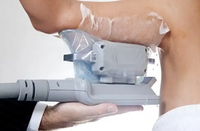Picture of fat freezing Leominster on the upper arms.