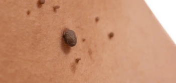 image of a skin tag Leominster