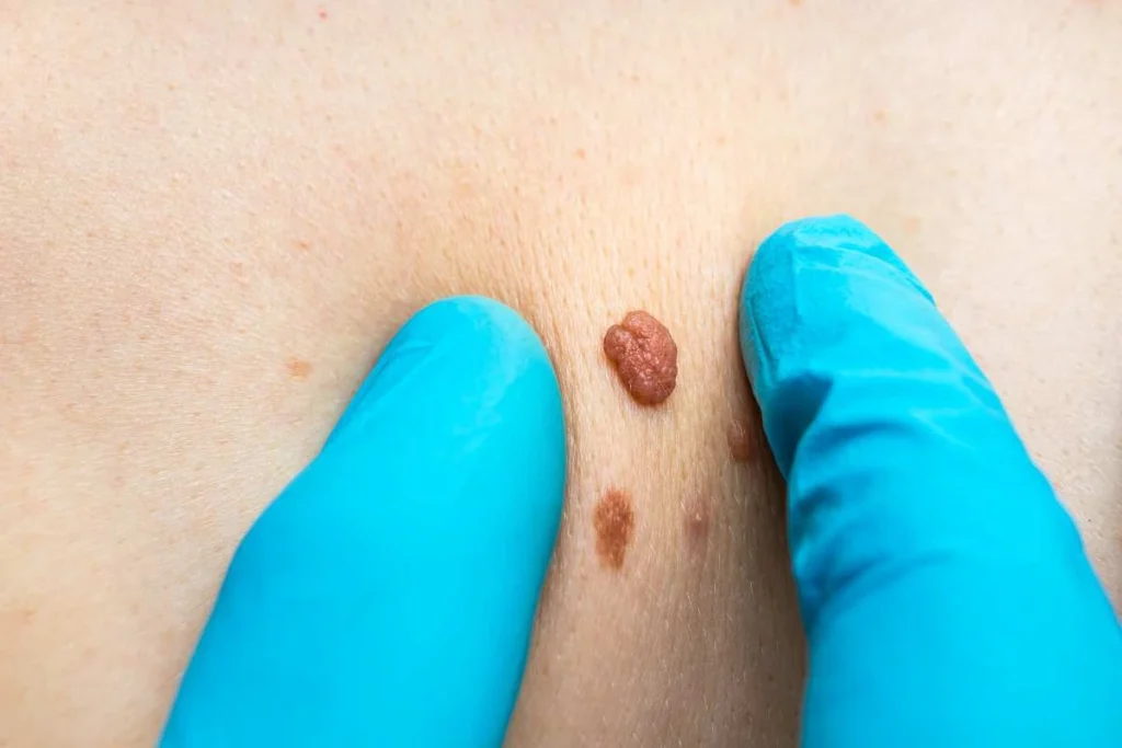 Consultant examining a skin tag Leominster