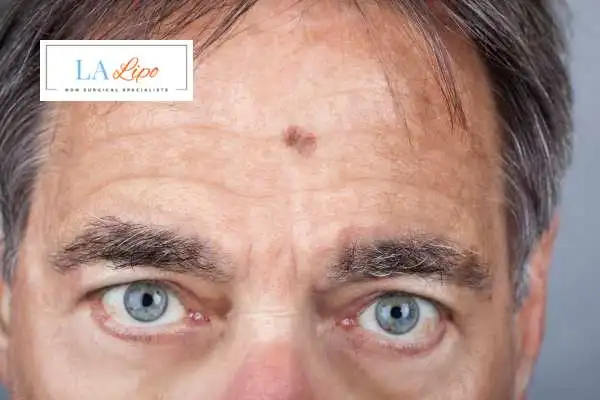 Solar Lentigo Removal Leominster image of man with mark on his forehead