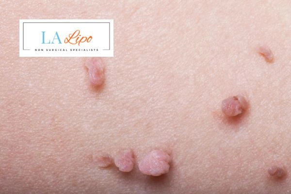 Does cryopen skin tag removal Leominster hurt? Find out now call our team today!
