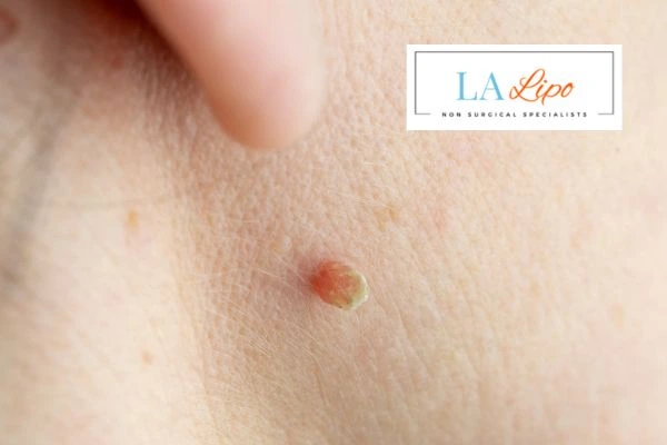 Book skin tag removal Leominster today speak to our team now!