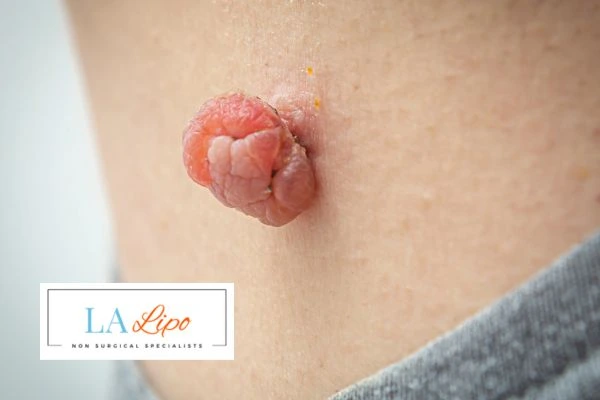 Interested in skin tag removal Leominster? Concerned about the pain? Find out more today!