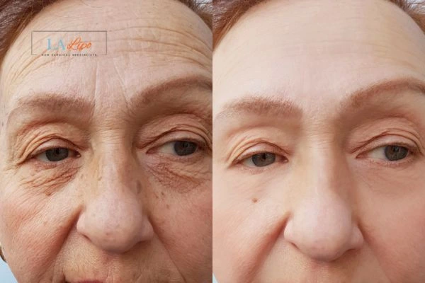 The powerful benefits of Morpheus8 Treatment Leominster - Call Our team today!