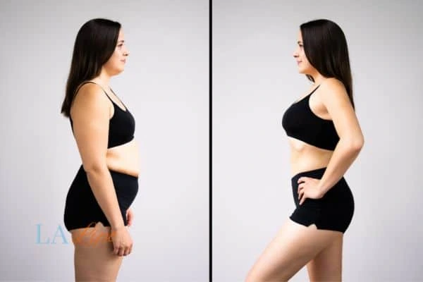 Picture of womans before and after using LA-EMS body sculpting to improve her core strength Leominster