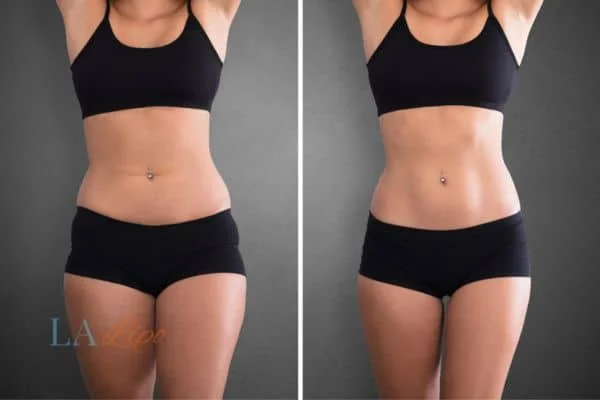 before and after results of non-surgical treatment to help a woman's body image and mental health Leominster