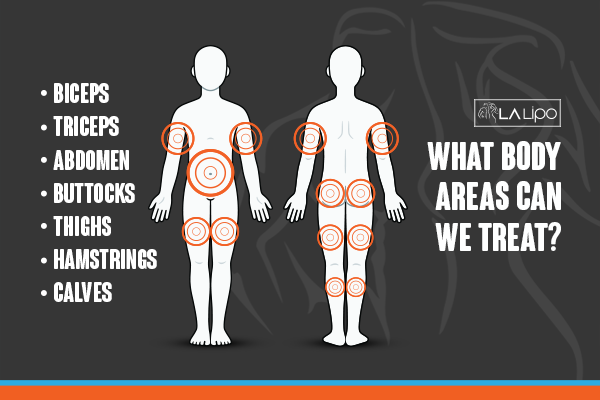 Diagram to show areas you can have LA-EMS Body Sculpting Treatment Leominster