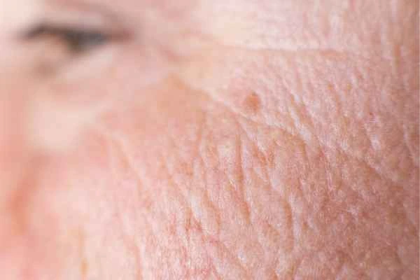 close up picture of a woman's face showing an age spot Leominster