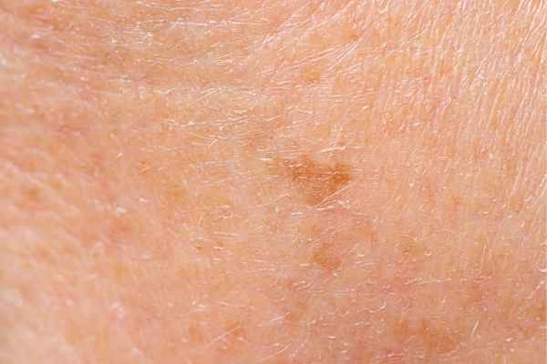close up picture of age spots Leominster
