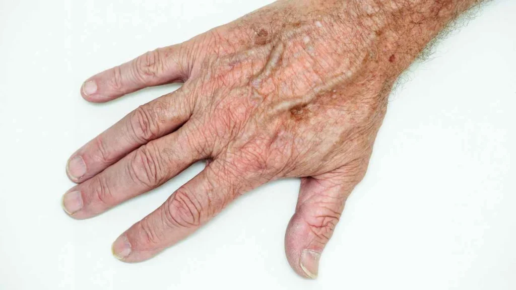 Male hand showing age spot Leominster