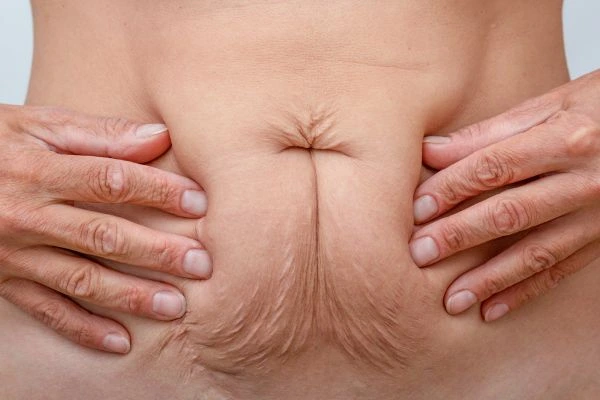 Should I Combine Diastasis Recti Treatment with Body Contouring for Better Results Leominster?