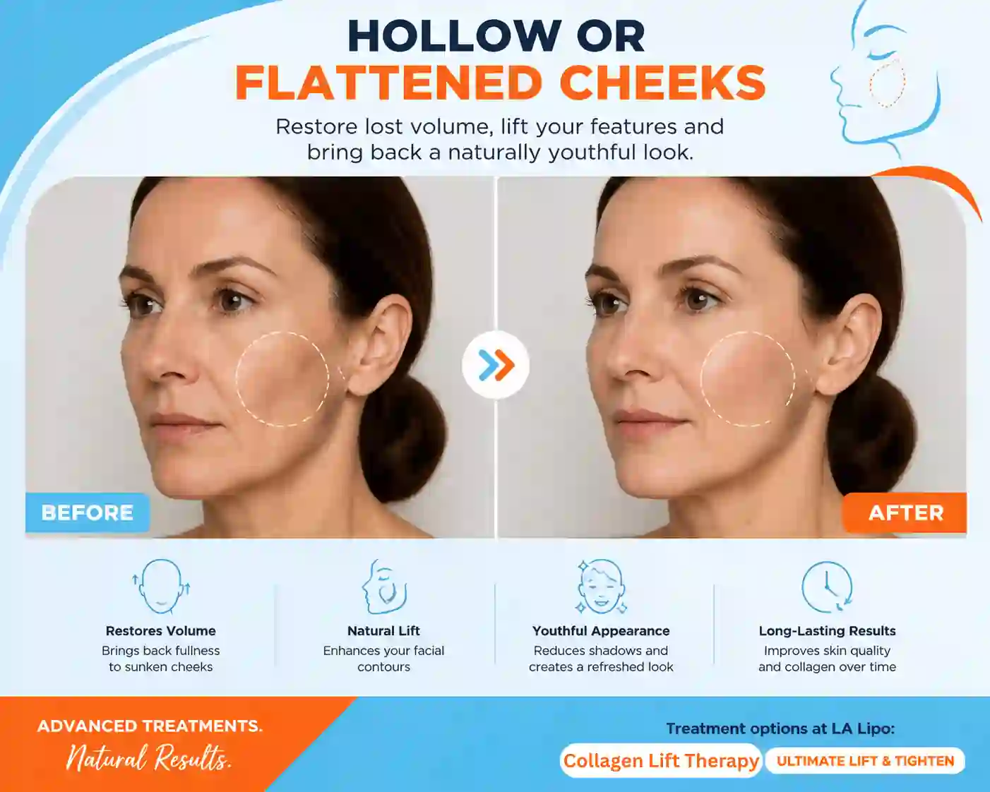 Sign #4: Hollow or Flattened Cheeks Leominster