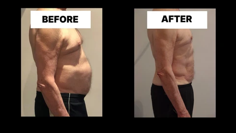 What Symptoms Can Diastasis Recti Cause in Men? Weak Core, Back Pain and Poor Posture Leominster